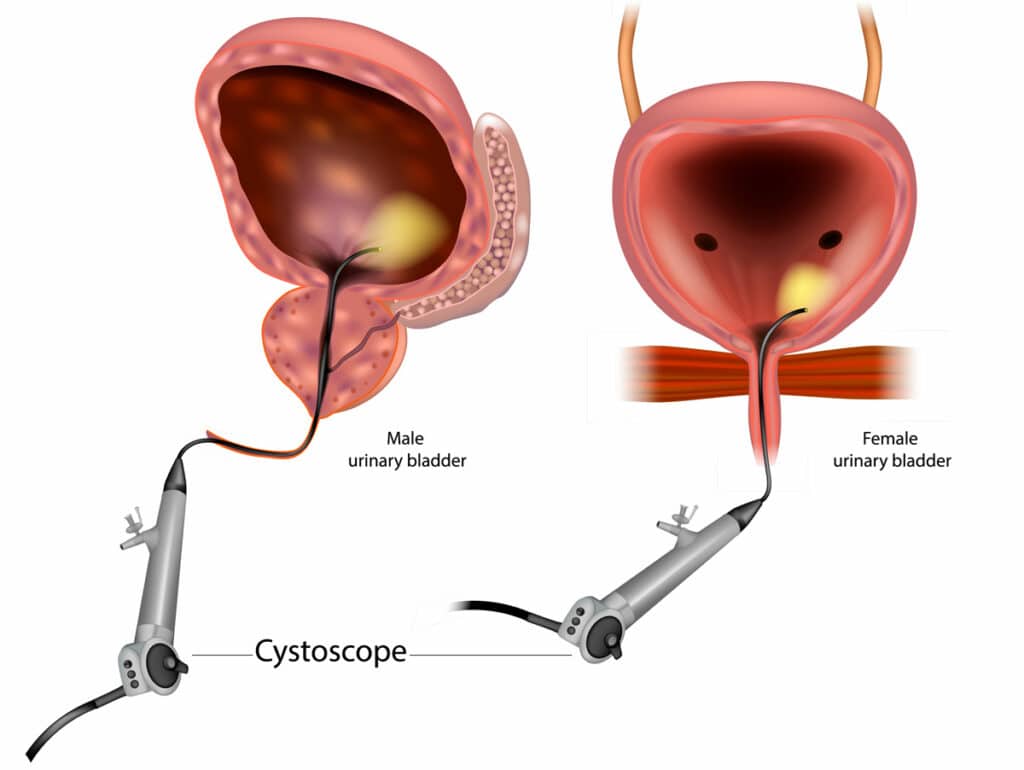 Diagnose and treat urinary tract issues with UroCare Specialist's advanced cystoscopy procedures. Our experienced urologists provide personalized care for optimal treatment outcomes. Learn more on our website.